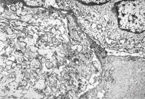 F,22y. | Pindborg tumor F,22y. | Pindborg tumor
